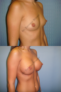 breast-aug-03-left