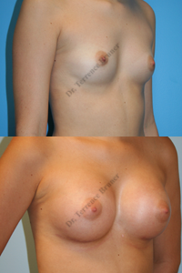 breast-aug-07-left