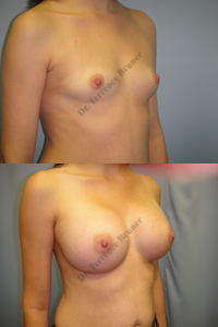 breast-aug-11-left