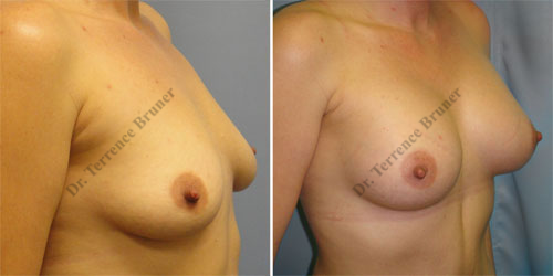 breast-aug-patient-01wm